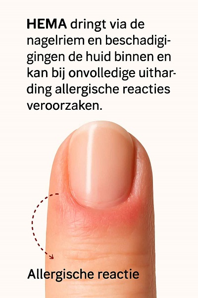 infographic_HEMA dringt de uit in met allergische reactie tot gevolg